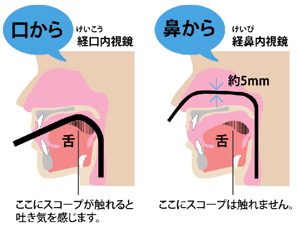 内視鏡検査